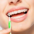 Ortodonti Tel Tedavisi Nedir?